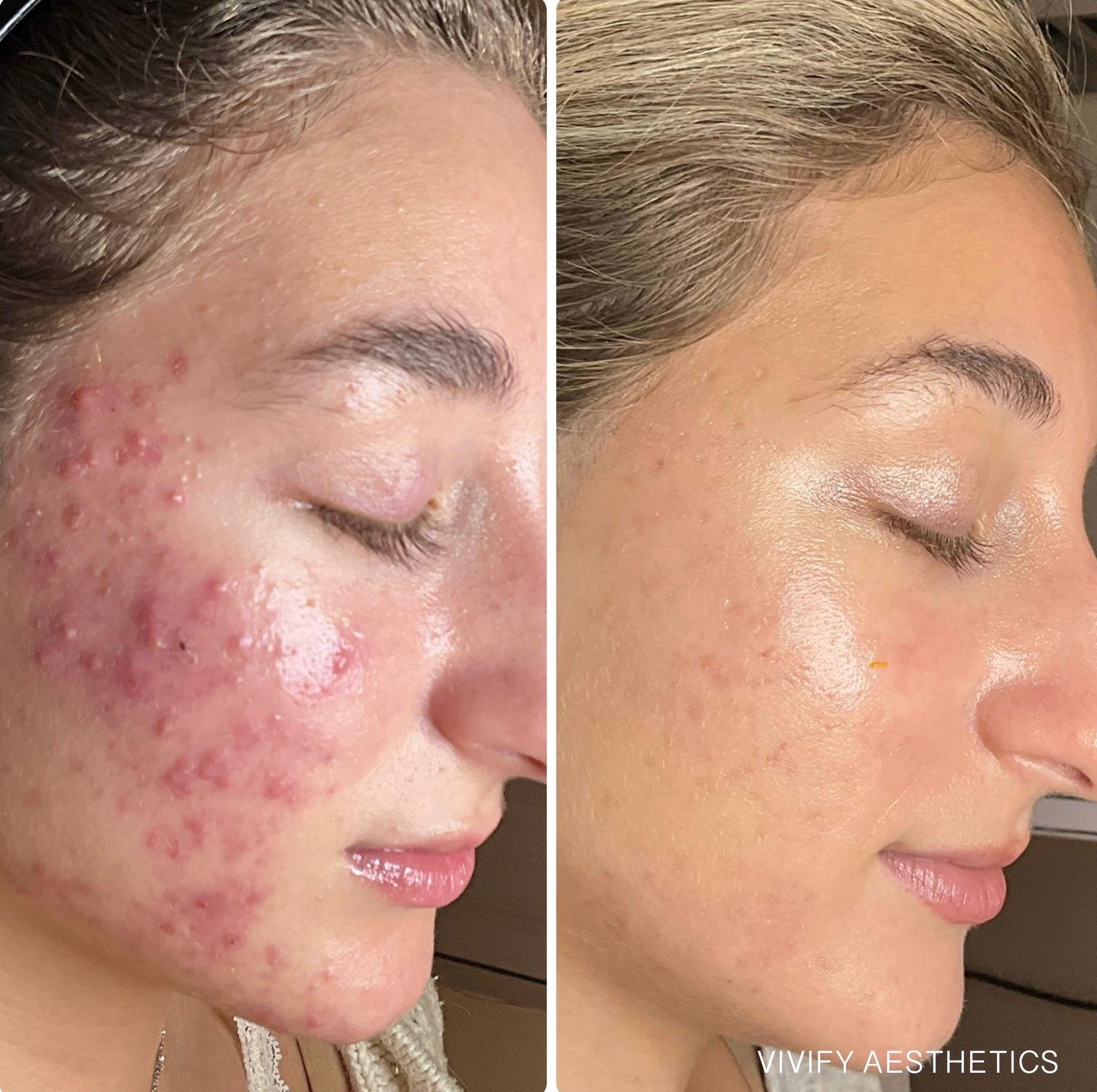 Acne Bootcamp before and after at Defiant Health in Lisle, IL: a client with active inflammatory acne on the left and clear, calm skin on the right after treatment