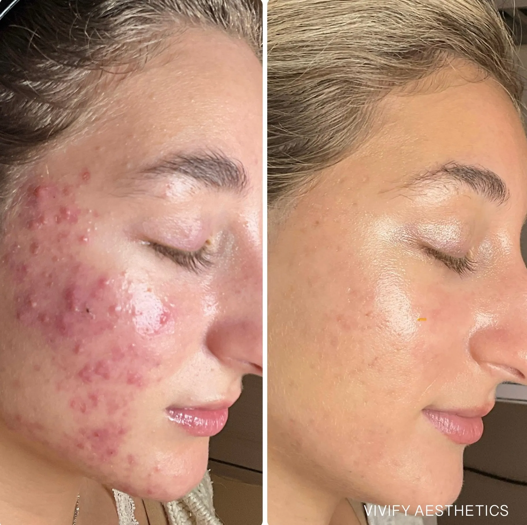 Acne Bootcamp before and after at Defiant Health in Lisle, IL: a client with active inflammatory acne on the left and clear, calm skin on the right after treatment