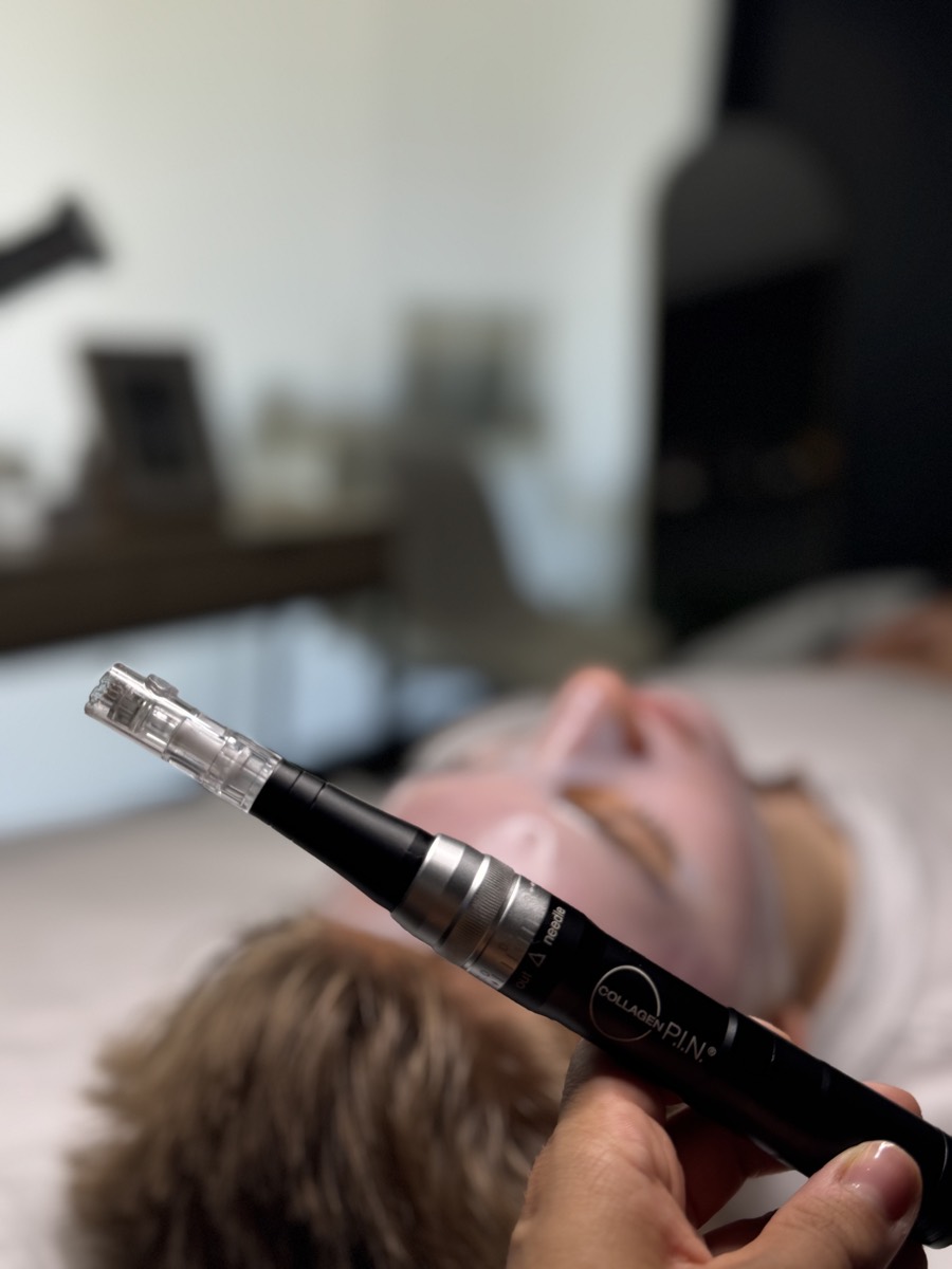 A microneedling pen in use during a collagen induction treatment at Defiant Health in Lisle, IL