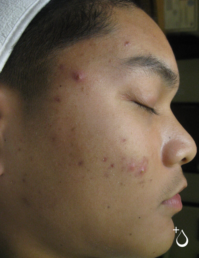 Defiant-Acne-Bootcamp-Before-Jason